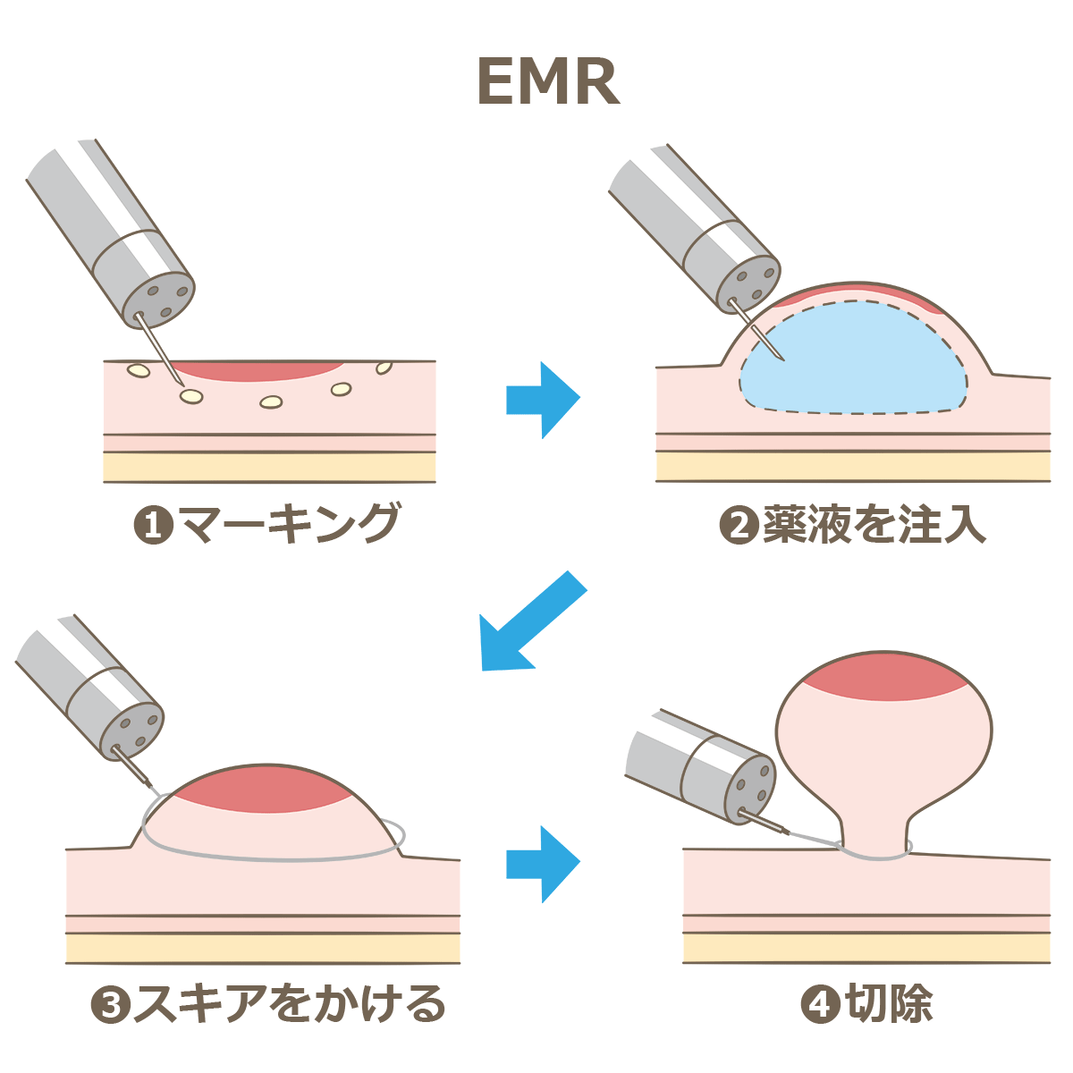 内視鏡的粘膜切除術（EMR）