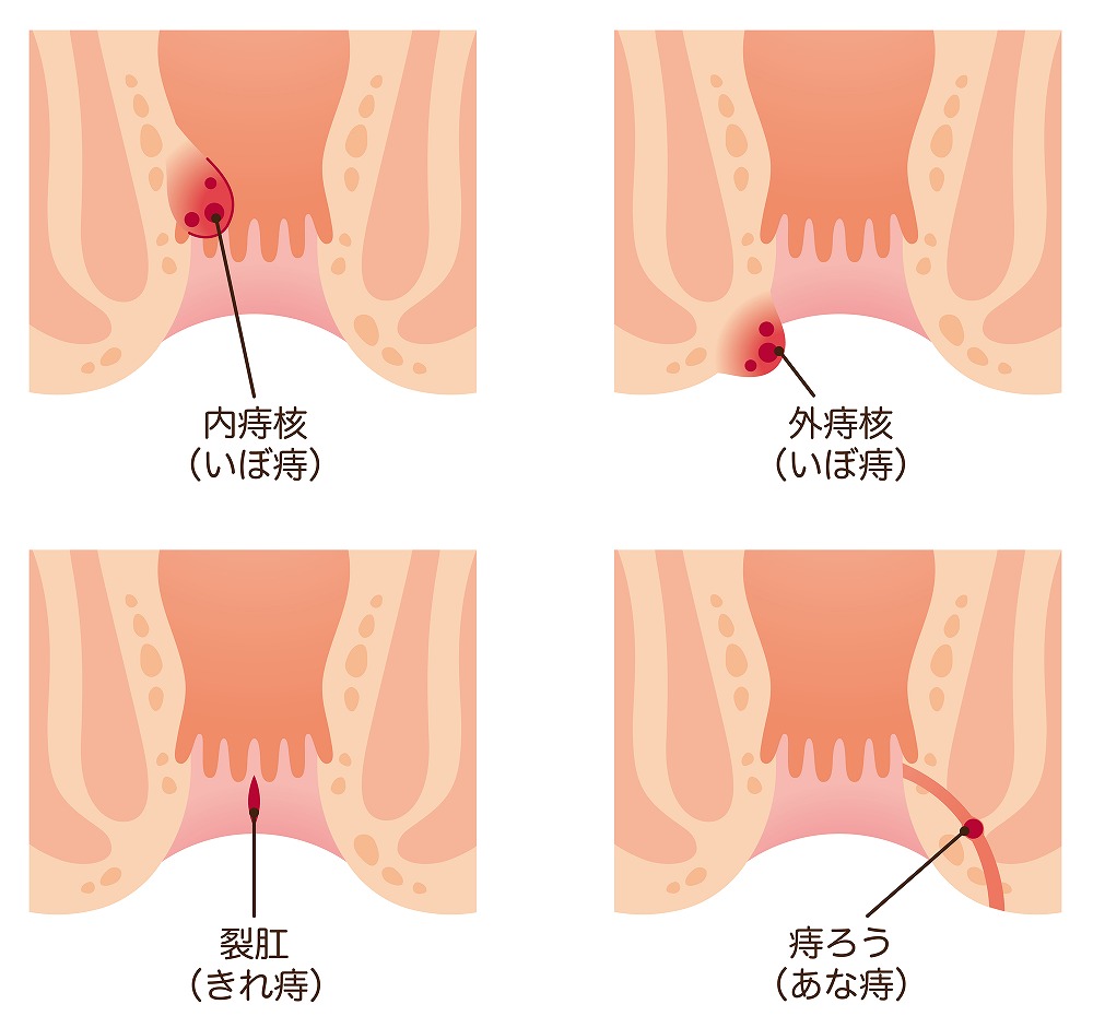 痔の種類